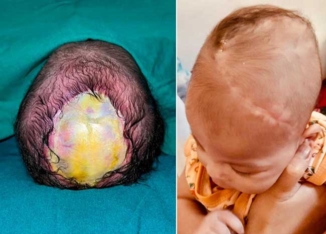 5-day-old infant operated on to correct rare skull defect in Mumbai hospital
