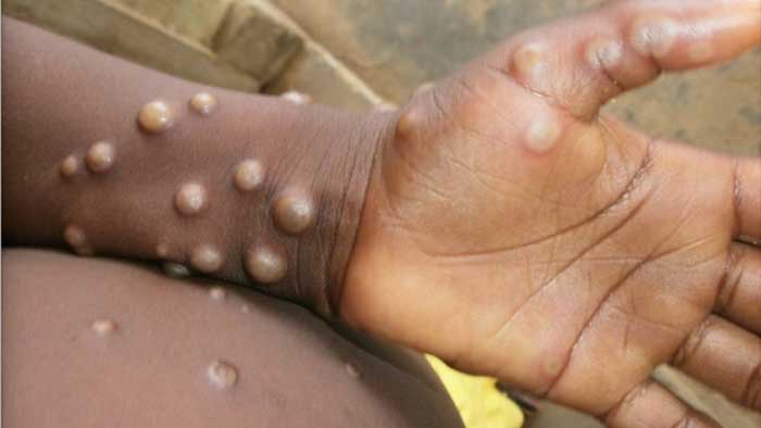 Monkeypox may slow down but not be eliminated: Report