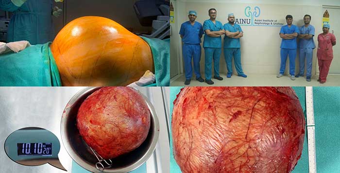 Doctors at Hyderabad hospital remove football-sized kidney tumour