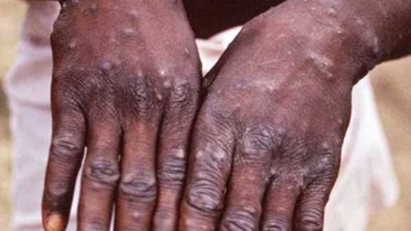 Canada confirms 235 monkeypox cases