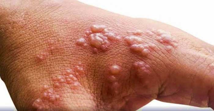 Confirmed: Kerala youth's death first monkeypox casuality in India