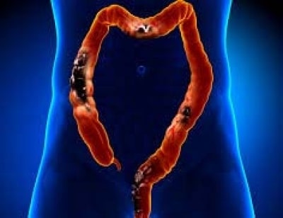 Scientists to probe if grape juice chemical can prevent bowel cancer